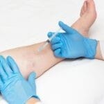 Tratamientos Minimamente Invasivos para Varices en Centro Adiós Varices